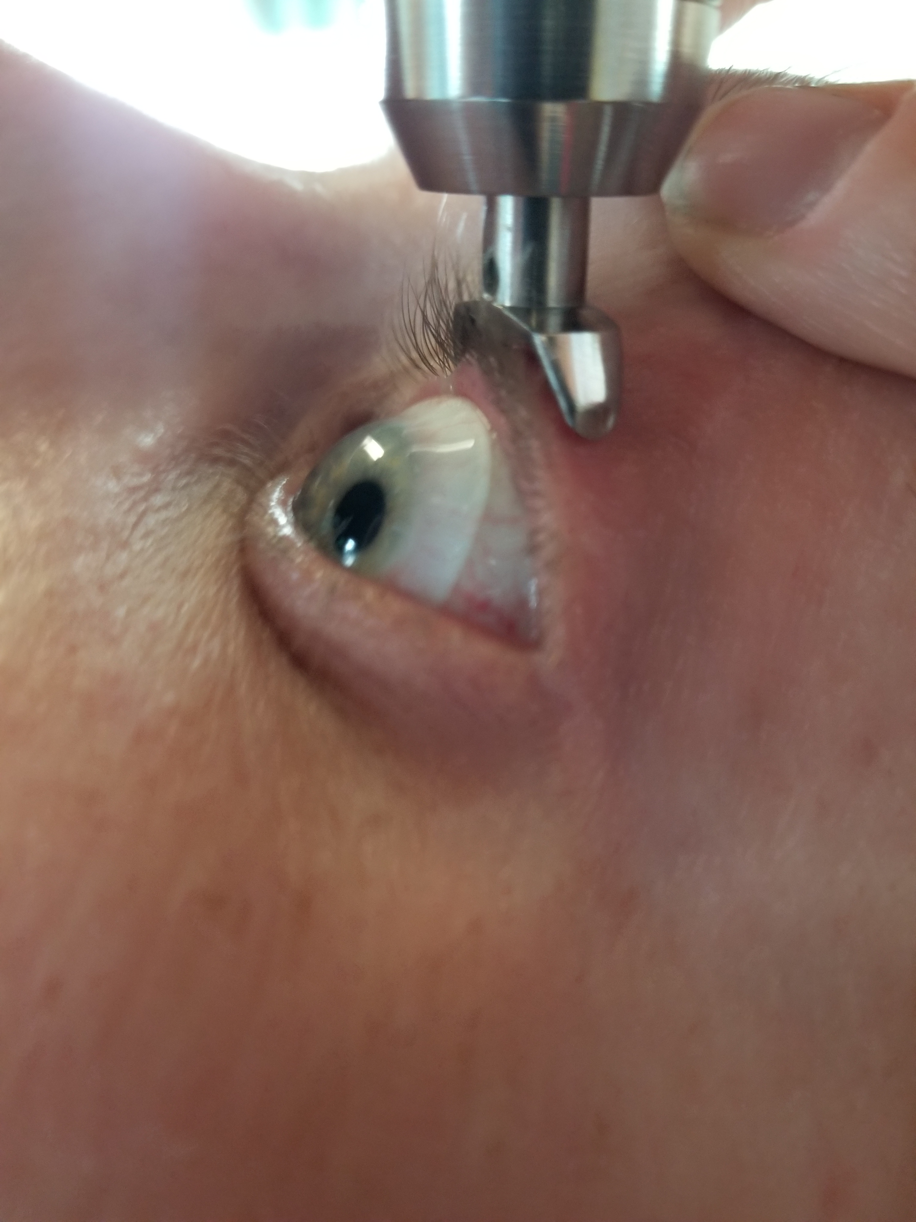 Scleral Lens and Diaton Tonometry