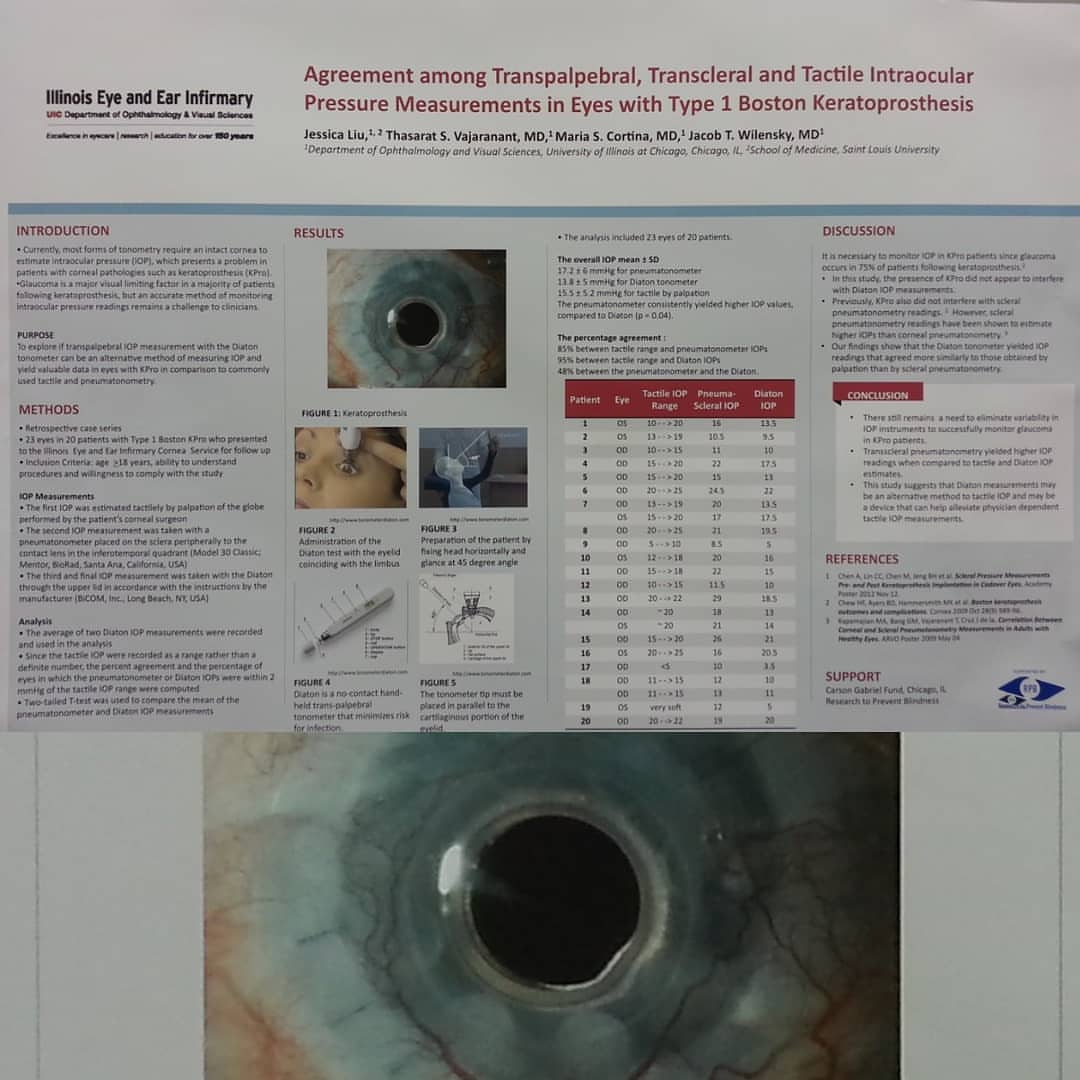 Agreement among Transpalpebral, Transcleral and Tactile Intraocular Pressure Measurements in Eyes with KPro Type 1 Boston Keratoprosthesis