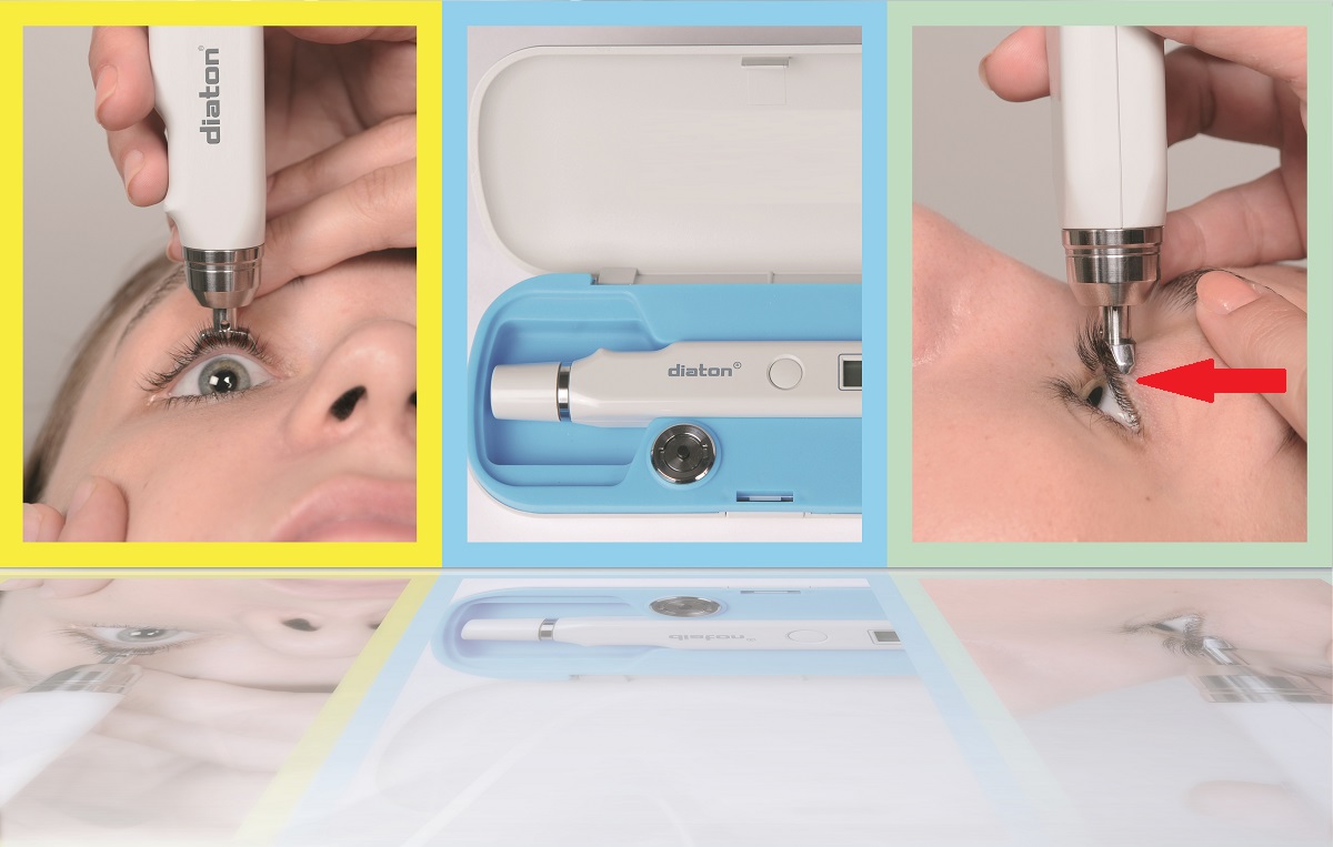 👁️‍🗨️💡Looking for the best way to measure intraocular pressure? #Diaton through eyelid tonometer is the way to go! Here are the top reasons why: