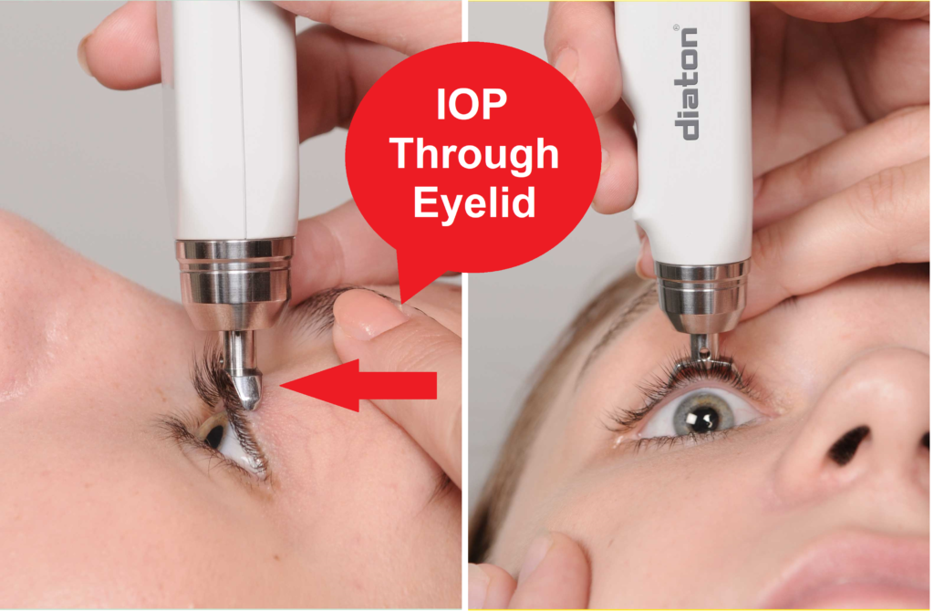 diaton tonometer IOP through eyelid
