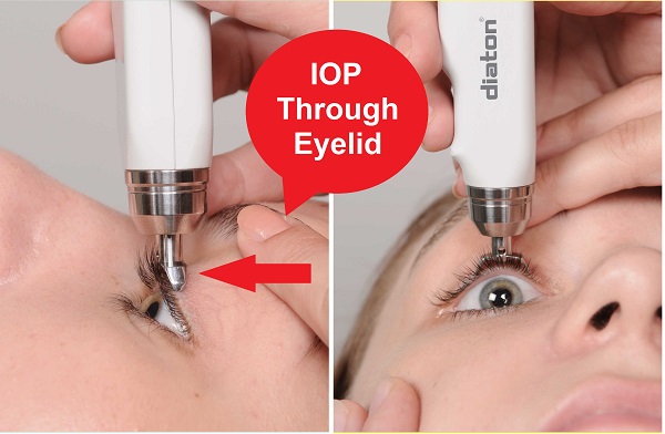 diaton tonometer IOP through eyelid