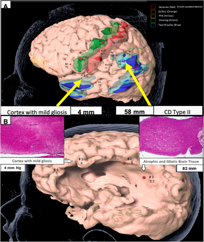 Use of DIATON Tonometer on the Brain to Identify Epileptogenic Lesions During Pediatric Epilepsy Surgery