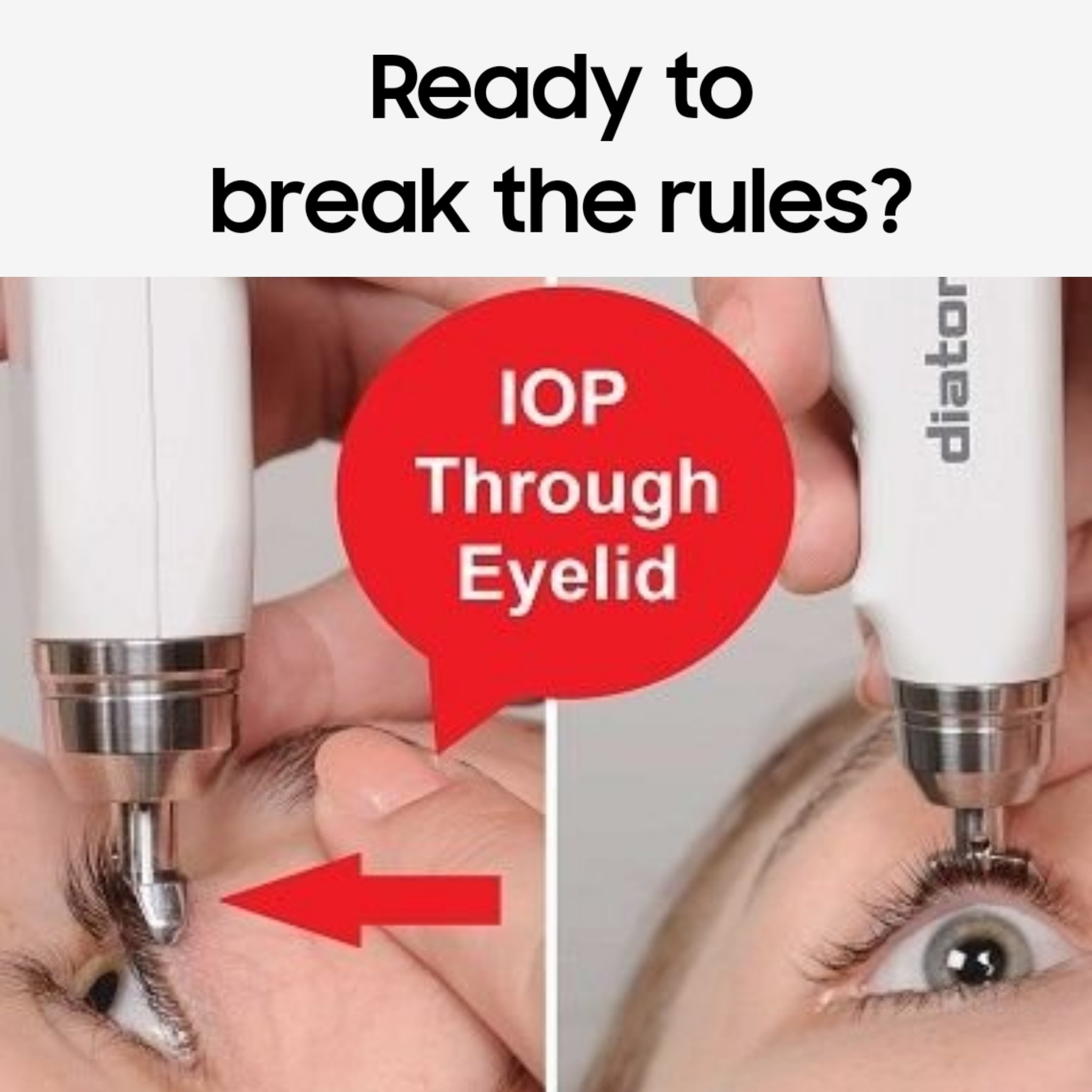Ready to Break the Rules?  IOP THROUGH EYELID with Diaton Transpalpebral Tonometer