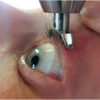 Diaton Tonometer with scleral lens on the eye