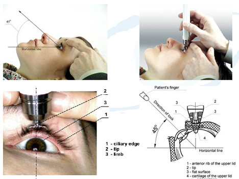 Title: Evaluating the Efficacy of Diaton Tonometer in Glaucoma Diagnostics: Overcoming the Challenges of Corneal Variability