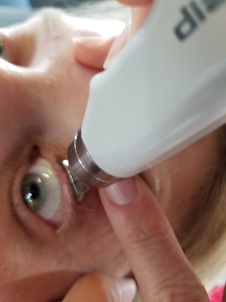 diaton tonometer is being used to measure intraocular pressure in the eye with scleral lens on the eye