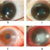 Keratitis Tonometry