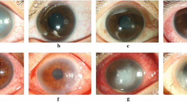 Keratitis Tonometry