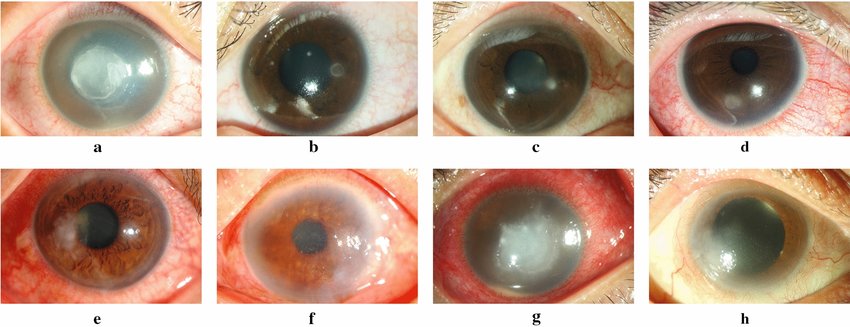 Keratitis Tonometry