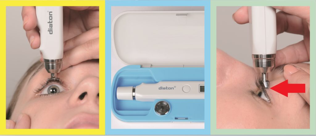 Diaton Tonometer, glaucoma eye test through eyelid, noncontact, non-invasive, painless glaucoma screening